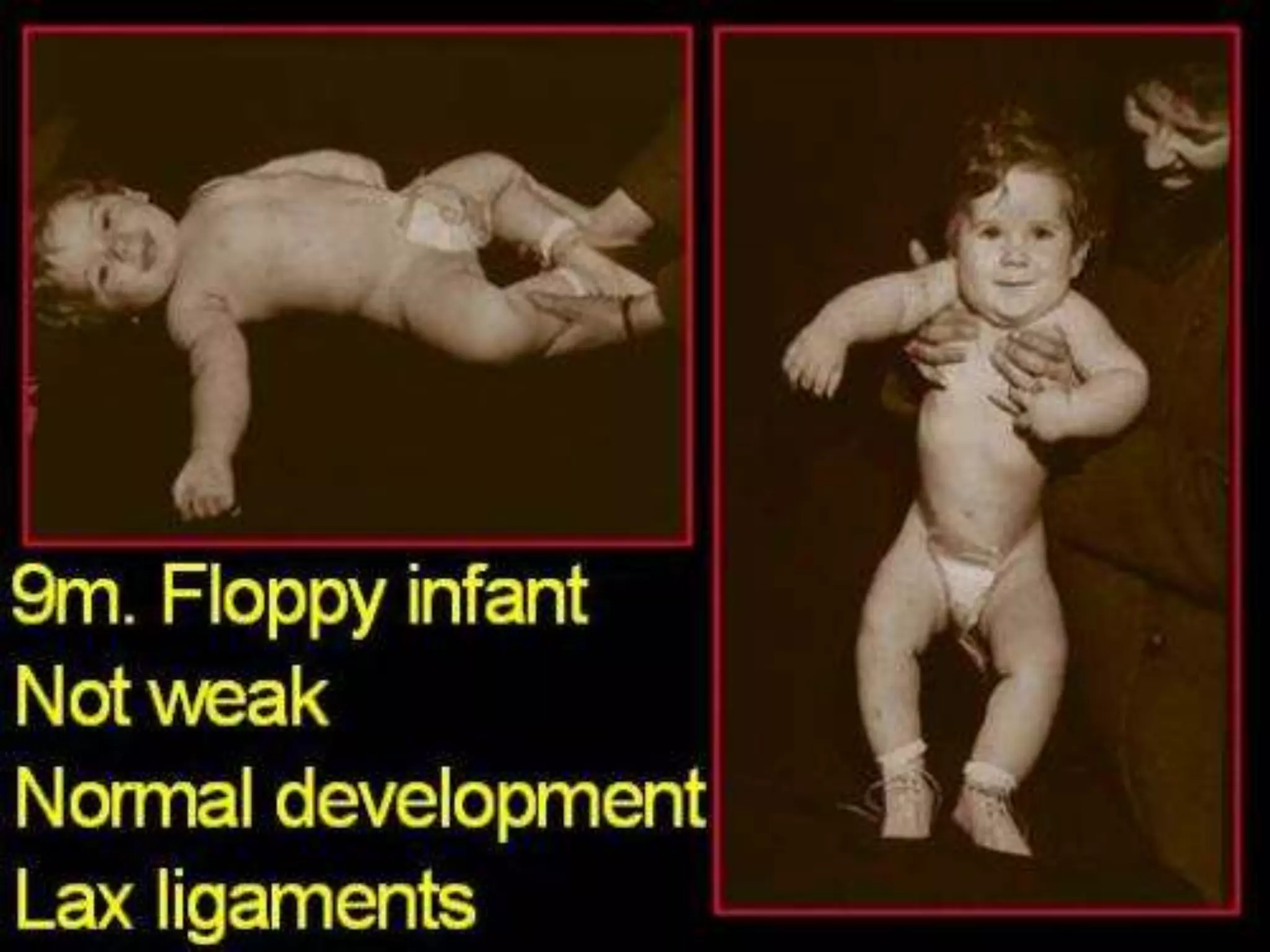 Approach to Floppy Infant.ppt