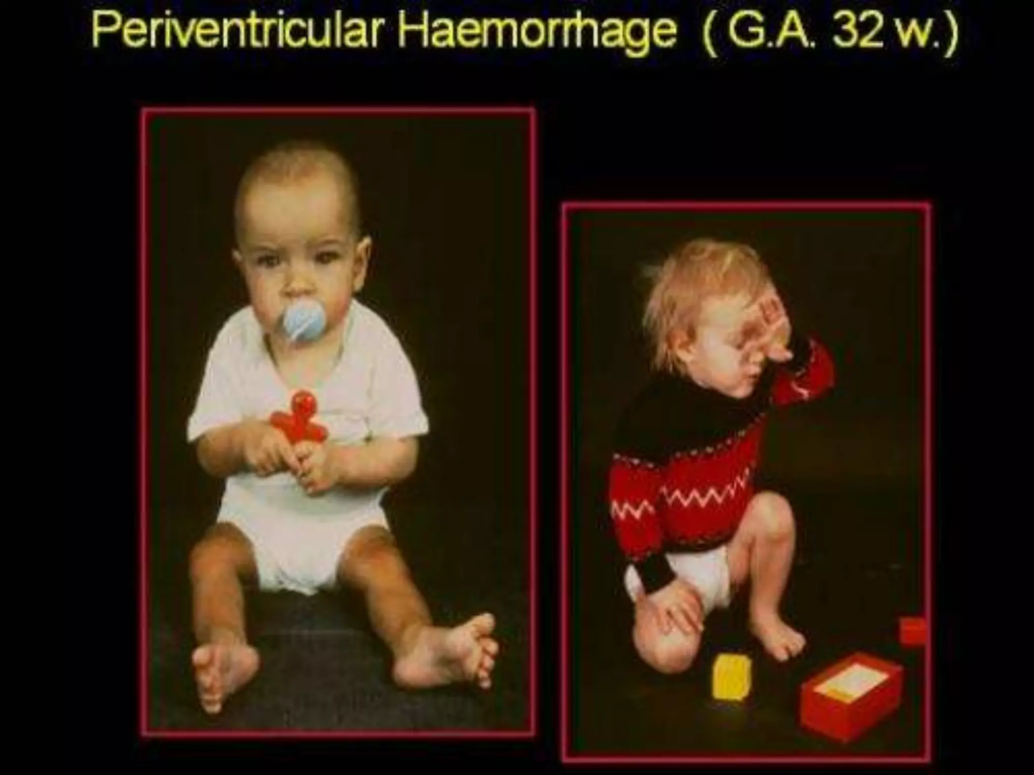 Approach to Floppy Infant.ppt
