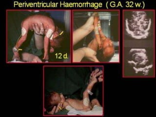 Neurology Chapter of IAP
 