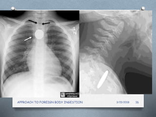 3/15/2018APPROACH TO FOREIGN BODY INGESTION 16
 