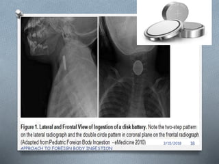 3/15/2018
APPROACH TO FOREIGN BODY INGESTION
18
 