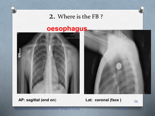 2. Where is the FB ?
AP: sagittal (end on) Lat: coronal (face )
oesophagus
3/15/2018APPROACH TO FOREIGN BODY INGESTION
26
 