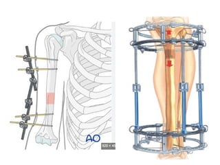 Bone Pressed Approach approach to fracture..................pptx