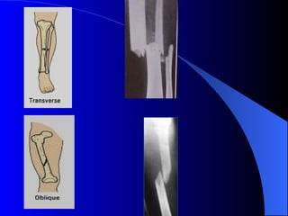 Tow Dislocation approach to fracture&dislocation,....ppt