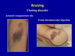 Approach to gastrointestinal bleeding | PPTX