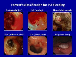 Forrest Class Approach to gastrointestinal bleeding | PPTX