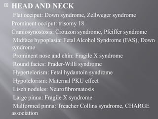  HEAD AND NECK
Flat occiput: Down syndrome, Zellweger syndrome
Prominent occiput: trisomy 18
Craniosynostosis: Crouzon syndrome, Pfeiffer syndrome
Midface hypoplasia: Fetal Alcohol Syndrome (FAS), Down
syndrome
Prominent nose and chin: Fragile X syndrome
Round facies: Prader-Willi syndrome
Hypertelorism: Fetal hydantoin syndrome
Hypotelorism: Maternal PKU effect
Lisch nodules: Neurofibromatosis
Large pinna: Fragile X syndrome
Malformed pinna: Treacher Collins syndrome, CHARGE
association
 