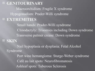  GENITOURINARY
Macroorchidism: Fragile X syndrome
Hypogonadism: Prader-Willi syndrome
 EXTREMITIES
Small hands: Prader-Willi syndrome
Clinodactyly: Trisomies including Down syndrome
Transverse palmer crease: Down syndrome
 SKIN
Nail hypoplasia or dysplasia: Fetal Alcohol
Syndrome
Port wine hemangioma: Sturge-Weber syndrome
Café au lait spots: Neurofibromatosis
Ashleaf spots: Tuberous Sclerosis
 