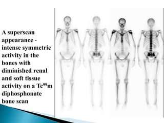 Superscan Bone Approach to generalised increased bone density | PPTX