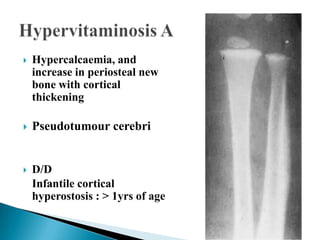 Hypervitaminosis D Radiology
