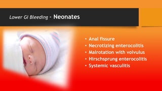 Lower GI Bleeding - Neonates
• Anal fissure
• Necrotizing enterocolitis
• Malrotation with volvulus
• Hirschsprung enterocolitis
• Systemic vasculitis
 