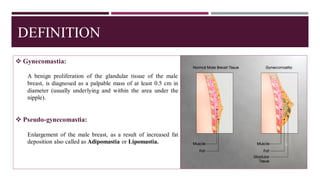 DEFINITION
❖ Gynecomastia:
A benign proliferation of the glandular tissue of the male
breast, is diagnosed as a palpable mass of at least 0.5 cm in
diameter (usually underlying and within the area under the
nipple).
❖ Pseudo-gynecomastia:
Enlargement of the male breast, as a result of increased fat
deposition also called as Adipomastia or Lipomastia.
 