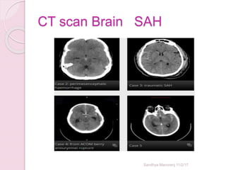 CT scan Brain SAH
Sandhya Manorenj 11/2/17
 