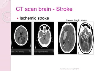 CT scan brain - Stroke
 Ischemic stroke
Sandhya Manorenj 11/2/17
Hemorrhagic stroke
 