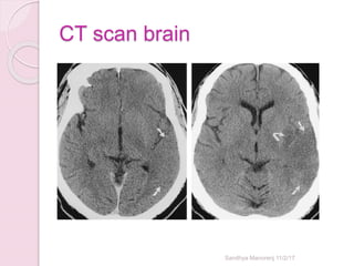 CT scan brain
Sandhya Manorenj 11/2/17
 