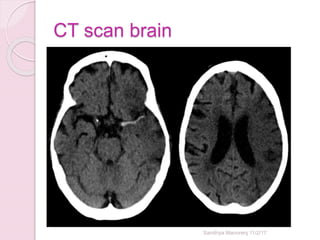 CT scan brain
Sandhya Manorenj 11/2/17
 