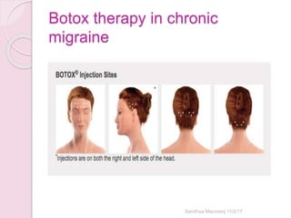 Botox therapy in chronic
migraine
Sandhya Manorenj 11/2/17
 
