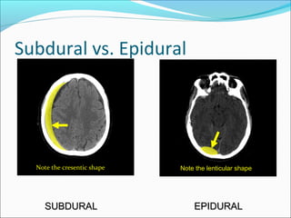 Subdural Classification Approach to head ct | PPT
