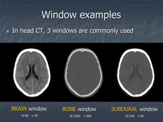 Window examples
BRAIN window
W:80 L:40
BONE window
W:2500 L:480
SUBDURAL window
W:350 L:90
 In head CT, 3 windows are commonly used
 