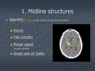 1. Midline structures
 Identify: (click on the names to see their location)
 Falx Cerebri
 Pineal gland
(usually calcified)
 Great vein of Galen
 Fornix
 