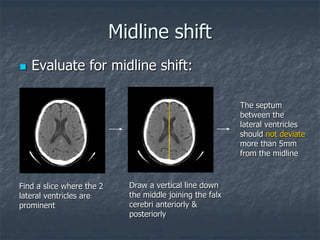 Midline shift
 Evaluate for midline shift:
Find a slice where the 2
lateral ventricles are
prominent
Draw a vertical line down
the middle joining the falx
cerebri anteriorly &
posteriorly
The septum
between the
lateral ventricles
should not deviate
more than 5mm
from the midline
 