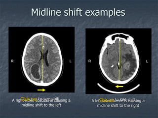 Midline shift examples
A right-sided abscess is causing a
midline shift to the left
A left-sided tumor is causing a
midline shift to the right
L L
R R
Click me to see shift Click me to see shift
 
