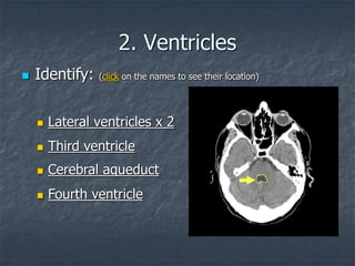 2. Ventricles
 Third ventricle
 Fourth ventricle
 Identify: (click on the names to see their location)
 Lateral ventricles x 2
 Cerebral aqueduct
 