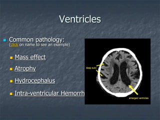  Common pathology:
(click on name to see an example)
 Hydrocephalus
 Intra-ventricular Hemorrhage
 Mass effect
 Atrophy
Ventricles
 