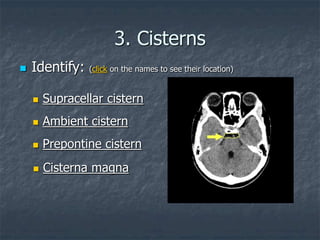 3. Cisterns
 Identify: (click on the names to see their location)
 Supracellar cistern
 Ambient cistern
 Prepontine cistern
 Cisterna magna
 