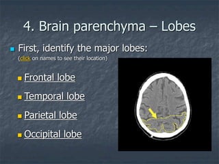 4. Brain parenchyma – Lobes
 First, identify the major lobes:
(click on names to see their location)
 Temporal lobe
 Occipital lobe
 Frontal lobe
 Parietal lobe
 