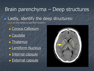 Brain parenchyma – Deep structures
 Lastly, identify the deep structures:
(click on the names to see their location)
 Thalamus
 Lentiform Nucleus
 Caudate
 Corpus Callosum
 Internal capsule
 External capsule
 
