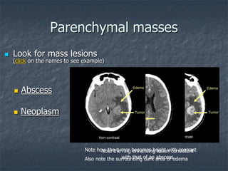  Look for mass lesions
(click on the names to see example)
 Abscess
 Neoplasm
Parenchymal masses
Note how the tumor becomes bright with contrast
Also note the surrounding dark area of edema
Note the ring enhancing lesion consistent
with that of an abscess
 
