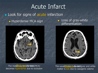 Acute Infarct
The middle cerebral artery (MCA)
becomes hyperdense due to occlusion
The usual border between grey and white
matter is lost due to vasogenic edema
 Hyperdense MCA sign
 Look for signs of acute infarction
 Loss of gray-white
differentiation
Click me to see Click me to see
 