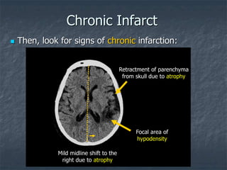 Chronic Infarct
 Then, look for signs of chronic infarction:
Mild midline shift to the
right due to atrophy
Retractment of parenchyma
from skull due to atrophy
Focal area of
hypodensity
 
