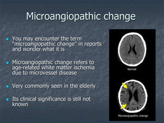 Microangiopathic change
 You may encounter the term
“microangiopathic change” in reports
and wonder what it is
 Microangiopathic change refers to
age-related white matter ischemia
due to microvessel disease
 Very commonly seen in the elderly
 Its clinical significance is still not
known
Microangiopathic change
Normal
 