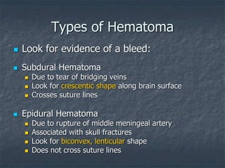 Types of Hematoma
 Look for evidence of a bleed:
 Subdural Hematoma
 Due to tear of bridging veins
 Look for crescentic shape along brain surface
 Crosses suture lines
 Epidural Hematoma
 Due to rupture of middle meningeal artery
 Associated with skull fractures
 Look for biconvex, lenticular shape
 Does not cross suture lines
 