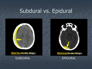 Subdural vs. Epidural
SUBDURAL EPIDURAL
Note the cresentic shape Note the lenticular shape
Click me to see shape Click me to see shape
 