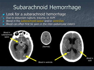 Subarachnoid Hemorrhage
Blood in
subarachnoid
space
Blood in
sulci
Blood in ventricle
 Look for a subarachnoid hemorrhage
 Due to aneurysm rupture, trauma, or AVM
 Blood in the subarachnoid space and/or ventricles
 Blood can often first be seen in the inter-peduncular cistern
(Normal)
 