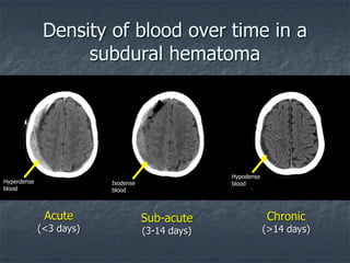 Density of blood over time in a
subdural hematoma
Acute
(<3 days)
Sub-acute
(3-14 days)
Chronic
(>14 days)
Hyperdense
blood
Isodense
blood
Hypodense
blood
 