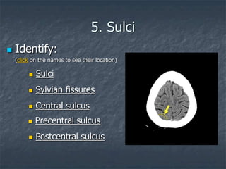 5. Sulci
 Central sulcus
 Precentral sulcus
 Sulci
 Sylvian fissures
 Postcentral sulcus
 Identify:
(click on the names to see their location)
 