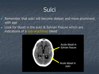 Sulci
 Remember that sulci will become deeper and more prominent
with age
 Look for blood in the sulci & Sylvian Fissure which are
indications of a sub-arachnoid bleed
Acute blood in
Sylvian fissure
Acute blood in
sulci
 