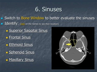 6. Sinuses
 Switch to Bone Window to better evaluate the sinuses
 Identify: (click on the names to see their location)
 Ethmoid Sinus
 Sphenoid Sinus
 Superior Saggital Sinus
 Frontal Sinus
 Maxillary Sinus
 