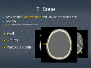 7. Bone
 Stay on the Bone Window and look at the bones now
 Identify:
(click on the names to see their location)
 Skull
 Sutures
 Mastoid air cells
 