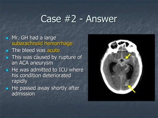 Case #2 - Answer
 Mr. GH had a large
subarachnoid hemorrhage
 The bleed was acute
 This was caused by rupture of
an ACA aneurysm
 He was admitted to ICU where
his condition deteriorated
rapidly
 He passed away shortly after
admission
 