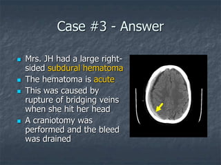 Case #3 - Answer
 Mrs. JH had a large right-
sided subdural hematoma
 The hematoma is acute
 This was caused by
rupture of bridging veins
when she hit her head
 A craniotomy was
performed and the bleed
was drained
 