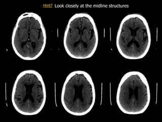 Subdural
Look closely at the midline structures
Hint?
 