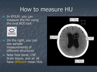 How to measure HU
 In EFILM, you can
measure the HU using
the oval ROI tool:
 On the right, you can
see sample
measurements of
different structures
 Note how bone, CSF,
brain tissue, and air all
have different mean HUs
 