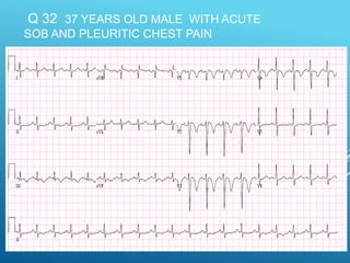 Q 32 37 YEARS OLD MALE WITH ACUTE
SOB AND PLEURITIC CHEST PAIN
 