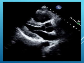 Normal Size LV ,
Dilated RV
 
