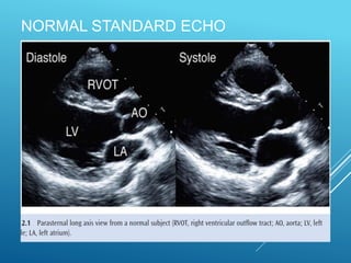 NORMAL STANDARD ECHO
 